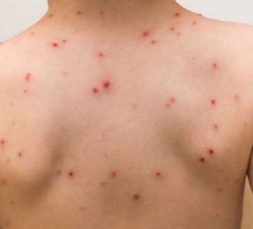 Emite Salud recomendaciones ante viruela símica